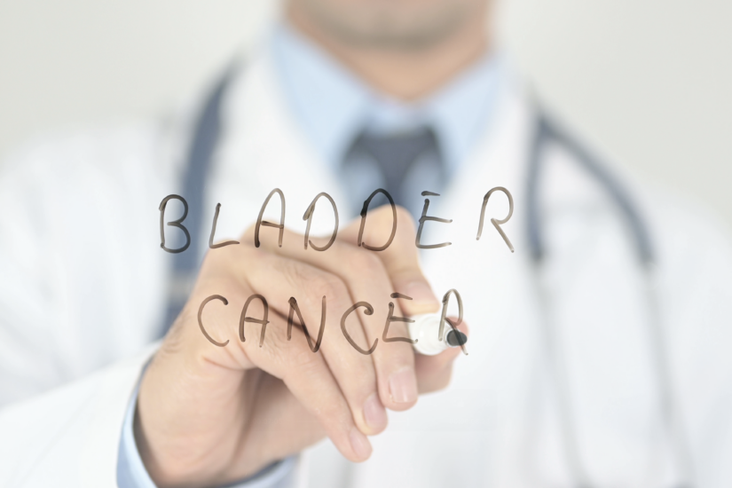 Neoplasia della vescica: sangue nelle urine e altri segnali da non sottovalutare